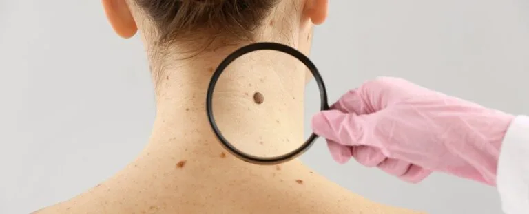 What are skin lesions - FACEMED