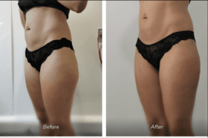 BodyTite liposuction procedure at FACEMED Essex – safe fat removal and skin tightening 