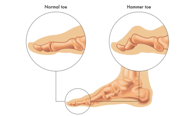 What is a Hammertoe