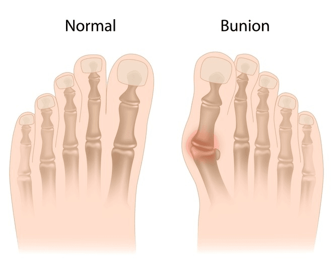 what is a bunion