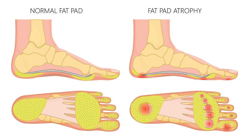 What are foot dermal fillers?